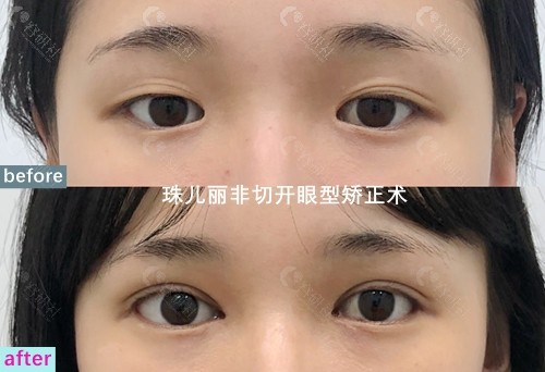 韩国珠儿丽整形外科眼部整形医生辛容元非切开眼型矫正手术图片