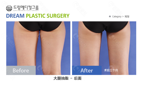 韩国梦想整形外科医院大腿吸脂对比