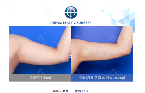 韩国梦想整形外科医院手臂吸脂对比