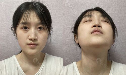 韩国原辰整形外科医院面部综合整形手术前鼻子情况