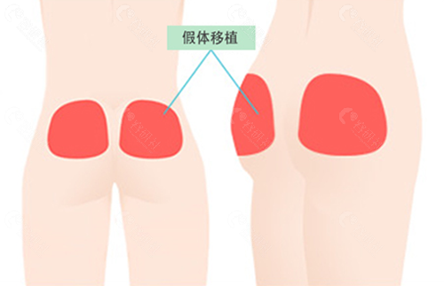 韩国珠儿丽整形外科丰臀手术