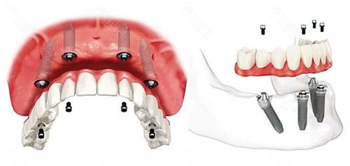 全口种植牙