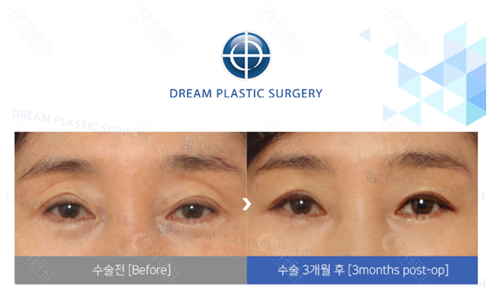 韩国梦想整形外科医院双眼皮修复对比图