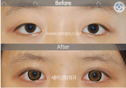 韩国世美整形医院双眼皮修复对比图