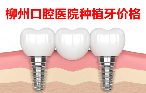 2023柳州口腔医院种植牙价格表