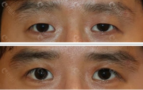 韩国爱护眼部提肌前后对比图