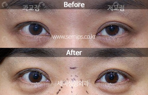 韩国世美眼部提肌修复前后对比