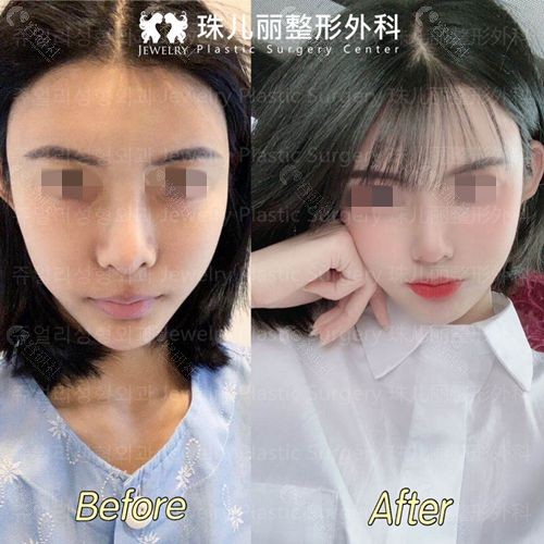 韩国珠儿丽整形外科隆鼻对比照