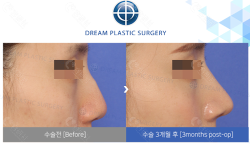 韩国梦想整形外科医院歪鼻矫正对比图