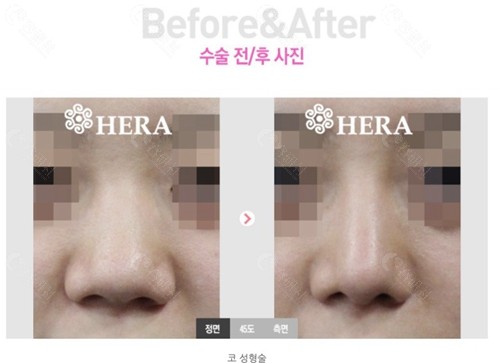 韩国赫拉整形医院鼻整形对比图