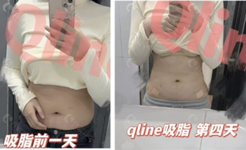 韩国Qline医院吸脂术前术后对比