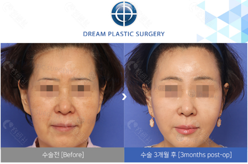 韩国梦想整形外科医院面部拉皮前后对比图