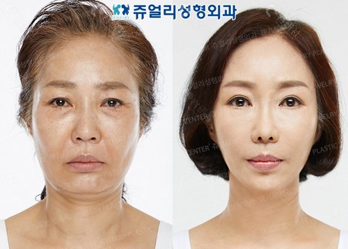 韩国珠儿丽整形外科mini小拉皮提升对比图