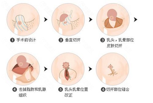 胸部缩小手术