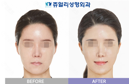 韩国珠儿丽整形外科拉皮手术对比