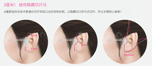 韩国ID整形外科拉皮手术方法