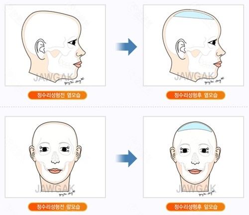 韩国雕刻整形外科骨水泥填充价格