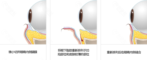 韩国梦想整形外科医院眼底脂肪重排方法