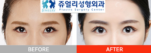 韩国珠儿丽整形外科眼底脂肪重排对比照
