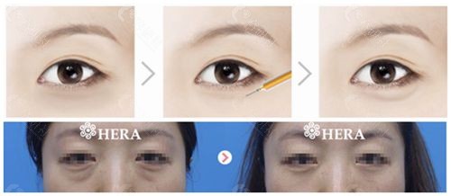 韩国赫拉整形外科眼底脂肪重排对比