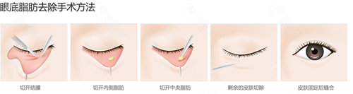 韩国必当归医院眼底脂肪重排方法