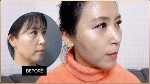 韩国丽延长整形外科面部除皱前后对比图