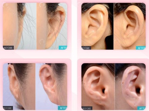 韩国普罗菲耳整形外科医院耳朵整形照片