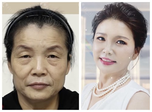 韩国珠儿丽50岁拉皮手术对比图