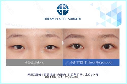 韩国梦想整形外科朴良洙埋线双眼皮+提肌+内眼角+眼角下至术前和术后三月对比照