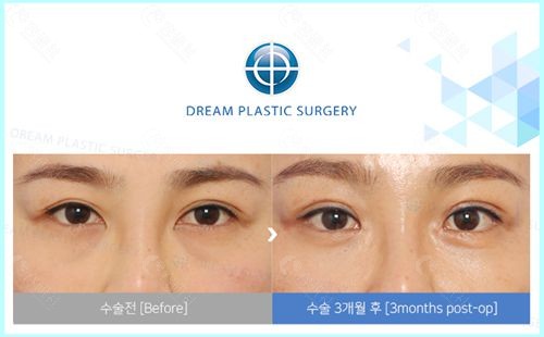 韩国梦想整形外科朴良洙埋线双眼皮+眼角内疵+眼肌矫正+眼袋手术前后对比照