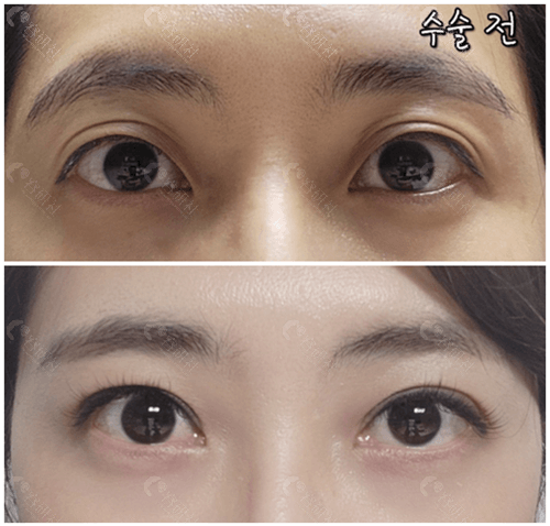韩国THE整形外科医院双眼皮对比照