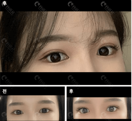 韩国欧佩拉整形外科双眼皮对比照