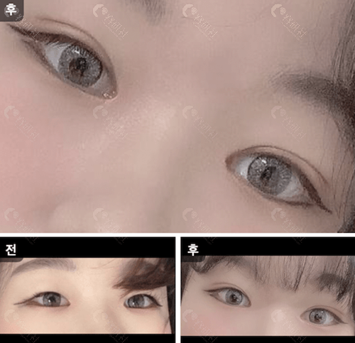 韩国大眼睛整形外科双眼皮对比照