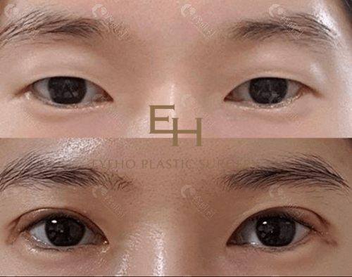 韩国爱护整形医院双眼皮对比照