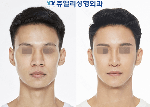 韩国珠儿丽整形外科隆鼻对比