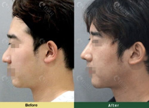 韩国优雅人整形外科医院鼻尖整形对比照