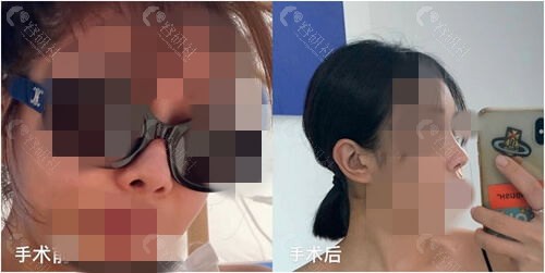韩国普罗菲耳整形外科医院鼻尖整形对比照