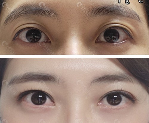 韩国THE整形外科上眼睑提肌修复前后对比