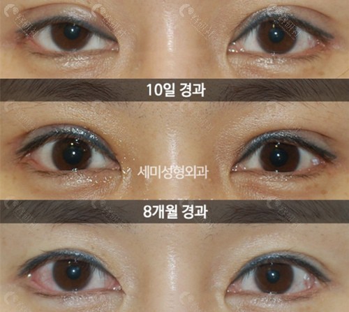 韩国世美上眼睑提肌修复术前术后对比