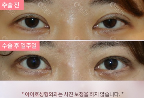 韩国爱护上眼睑提肌修复真人实例