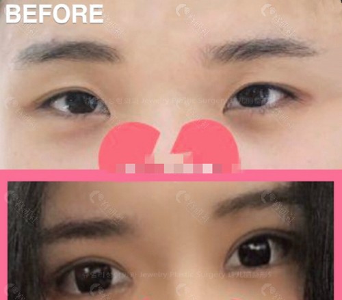 韩国珠儿丽上眼睑提肌修复前后对比照