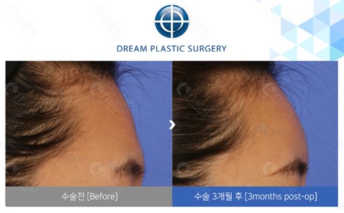 韩国梦想整形外科医院额头脂肪填充对比照