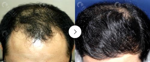 韩国布莱克BLACK毛发移植医院头顶加密种植图片