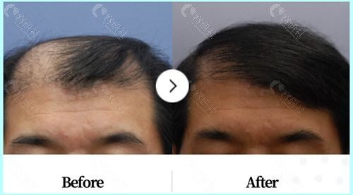 韩国布莱克毛发移植中心男性毛发移植前后对比图