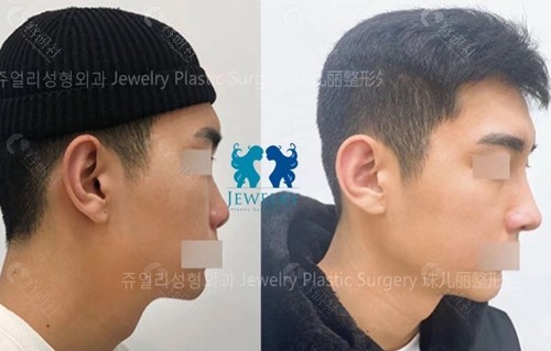韩国珠儿丽整形外科短鼻矫正对比图