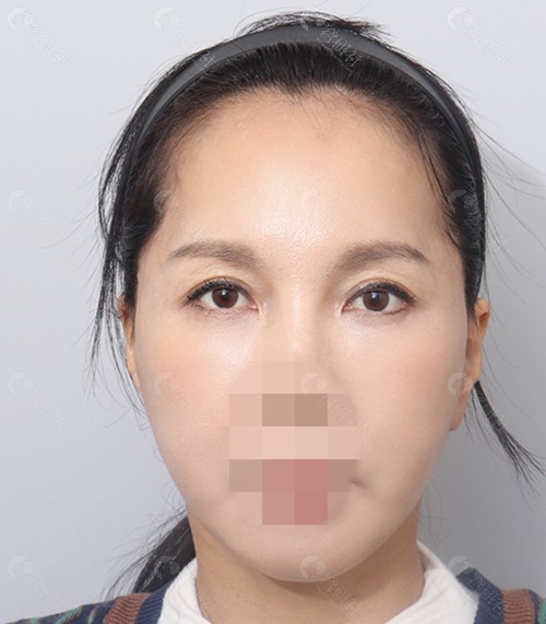 韩国面部提升术后三个月照片