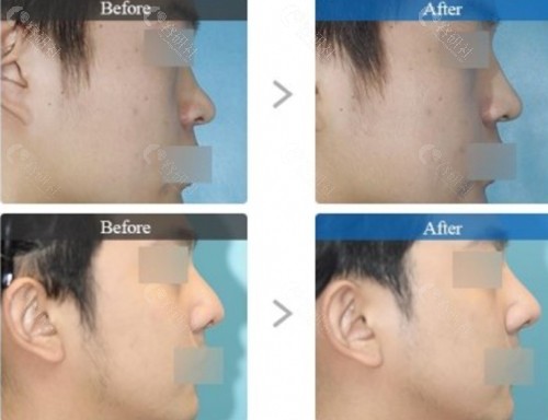 韩国碧夏男士隆鼻术前术后对比