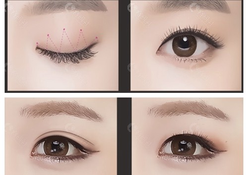 韩国爱护整形医院割双眼皮示意图