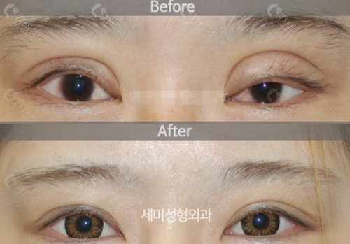 韩国世美整形外科双眼皮修复对比图