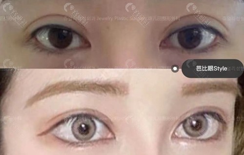 韩国珠儿丽整形外科割双眼皮手术对比图